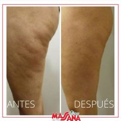 Tratamiento para la celulitis - Grupo Médico Clínicas Massana