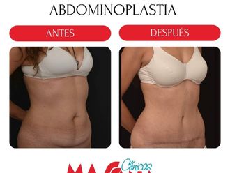 Abdominoplastia antes y después - 880251