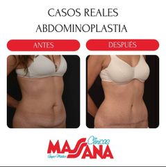 Abdominoplastia - Grupo Médico Clínicas Massana