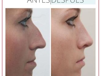 Rinoplastia antes y después - 880252
