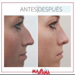 Rinoplastia - Grupo Médico Clínicas Massana