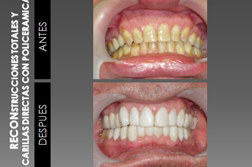 Carillas dentales antes y después - 226896