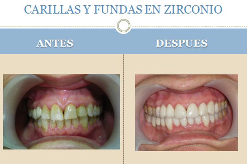 Ortodoncia antes y después - 226897