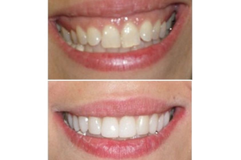 Carillas dentales antes y después - 494867