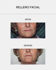Rellenos faciales - Clínica Vega