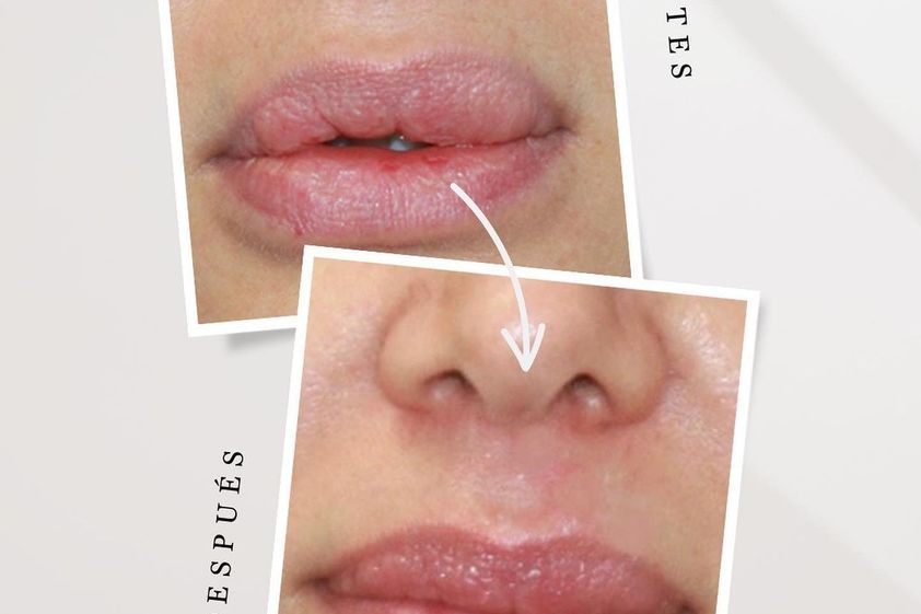 Queiloplastia antes y después - 847846