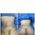 Liposucción y lipotransferencia