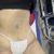 Liposucción y lipotransferencia