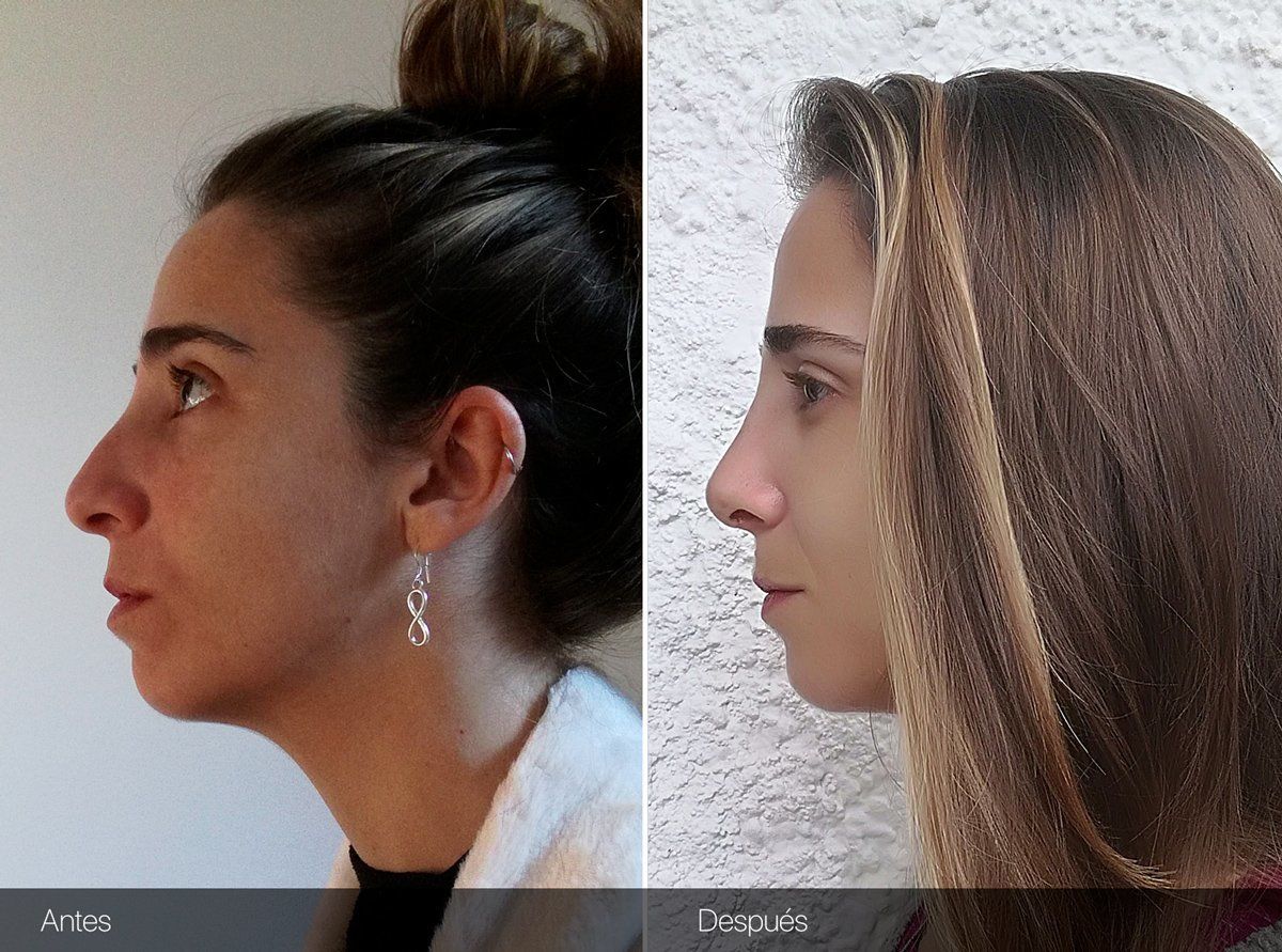 Septoplastia Antes Y Después Fotos SEPTOPLASTIA: Feliz! Puedo respirar!!! (Semana 1) - Rinoplastia