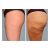 Stop y fuera cellulitis