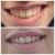 Tratamiento de sonrisa gingival y aumento de labios