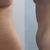 Hidrolipoclasia aspirativa abdomen y flancos