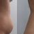 Hidrolipoclasia aspirativa abdomen y flancos