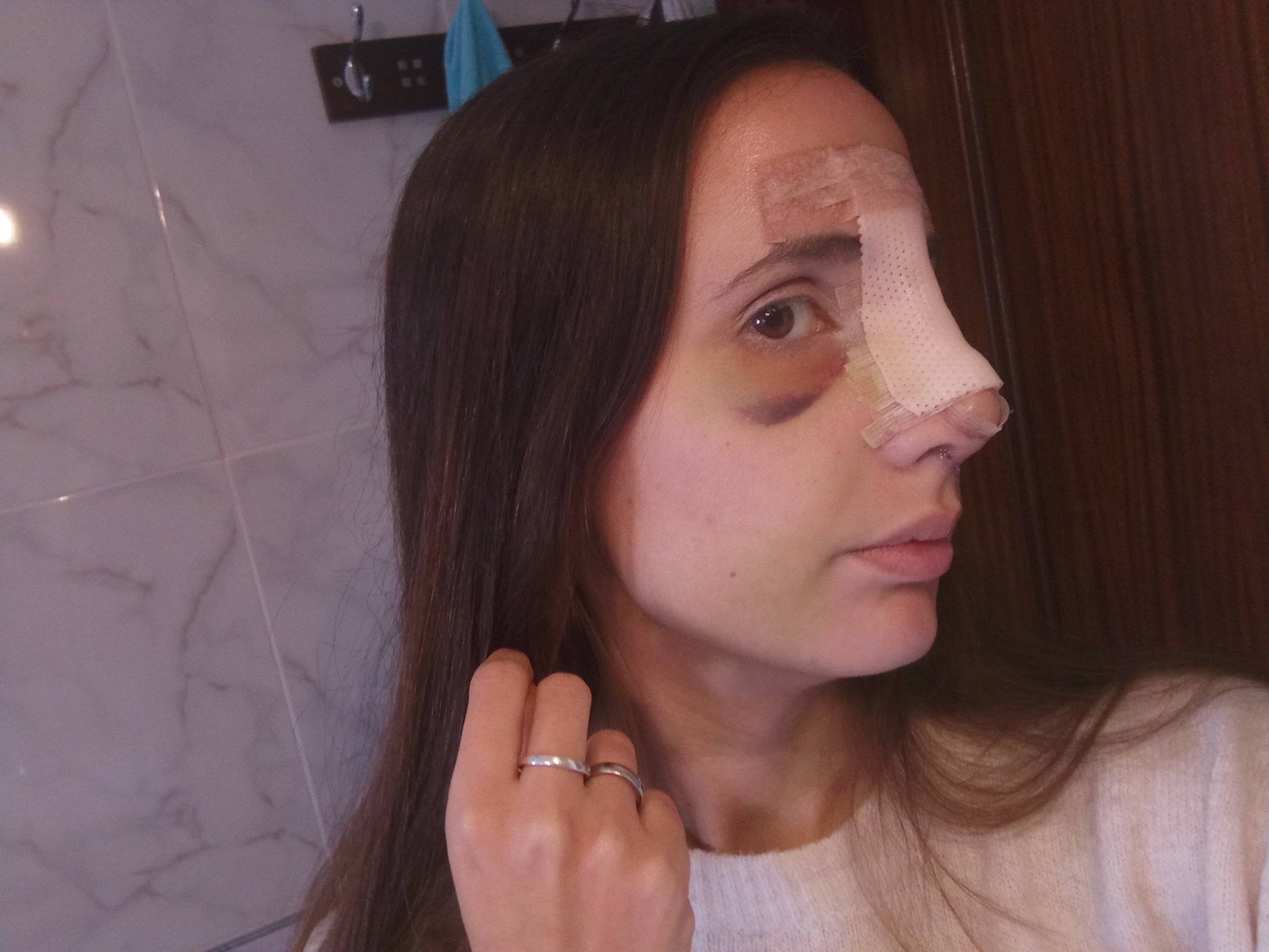 La nariz se siente obstruida después de la rinoplastia