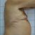 Mi abdominoplastia no invasiva en Inneo. Muy profesionales y muy contento