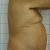 Mi abdominoplastia no invasiva en Inneo. Muy profesionales y muy contento