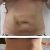 Lipólisis láser en abdomen