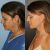 Lifting cervicofacial con técnica Deep Plane 3R. Un cambio real, sin perder mi expresión