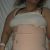 Lipo abdominoplastia