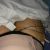 Lipo abdominoplastia