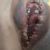 Hematoma post cirugía labioplastia