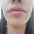 Mi experiencia con el perfilado de labios con ácido hialurónico