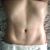 Me hice una Lipo HD con el Dr. Angel Tapia
