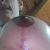 Mastopexia con cicatriz en ancla más implantes
