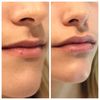 Remodelación de labios.  Genial - 61823