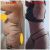 Lipoabdominoplastia y liposucción de flancos
