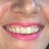 Aumento de labios juvederm ultra 3 - 60628