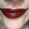 Aumento de labios juvederm ultra 3 - 60630