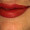 Aumento de labios juvederm ultra 3 - 60632