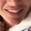Aumento de labios juvederm ultra 3 - 60633