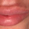 Aumento de labios juvederm ultra 3 - 60885