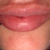 Aumento de labios juvederm ultra 3 - 60886