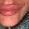 Aumento de labios juvederm ultra 3 - 60893