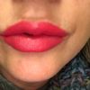Aumento de labios juvederm ultra 3 - 60959