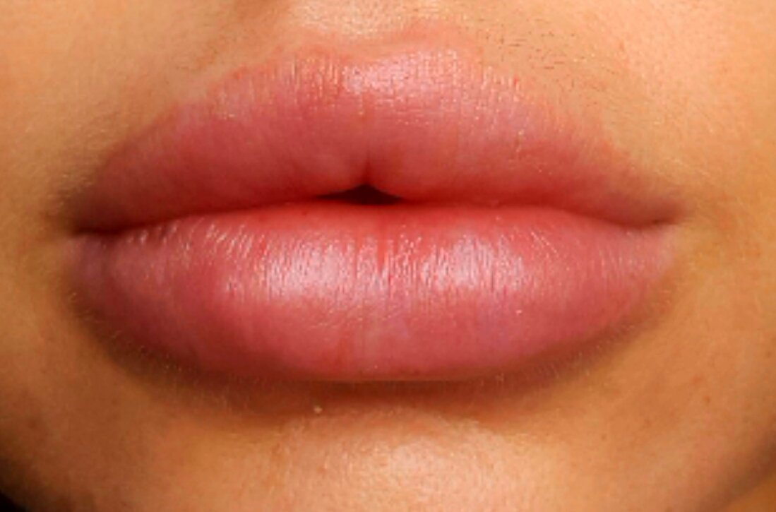 Como Moldear Los Bultitos De A H Labios Acido Hialuronico Multiestetica Com