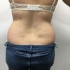 Hidrolipoclasia perfecta