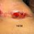 Heridas mastopexia abiertas y empeorando