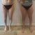 Liposucción con Bodytite en BCN- dos meses después