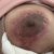 Mi cuerpo rechazó los puntos de la mastopexia