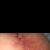 Mi cuerpo rechazó los puntos de la mastopexia