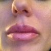 Aumento de labios con grasa - 19141