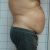 Abdominoplastia Capenergy