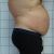Abdominoplastia Capenergy