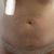 Abdominoplastia con lipovaser y lipo transferencia a glúteo