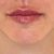 Aumento de labios naturales y armónico
