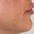 Aumento de labios naturales y armónico